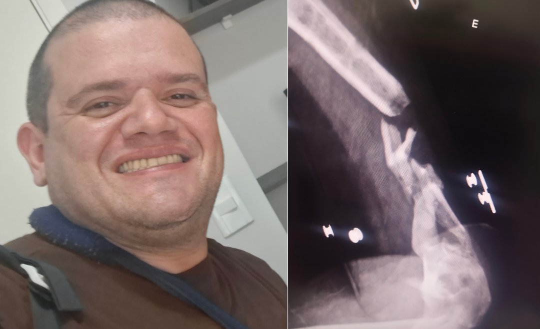 CIRURGIA NO ÚMERO COLOCAR FIXADORES